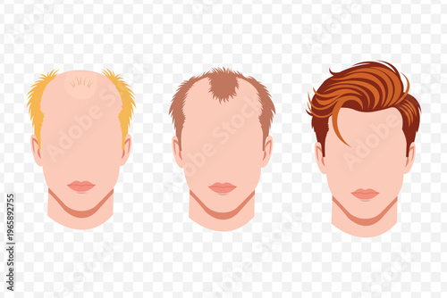 Stages of Male Hair Loss Progression: Thinning to Full Head of Hair Vector Illustration