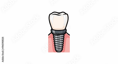 Stylized illustration of a dental implant with a crown inserted into gums