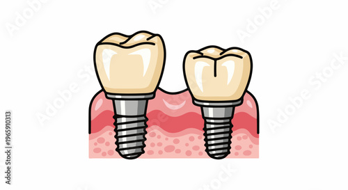 Two teeth implants shown in a simplified cross-section of gums