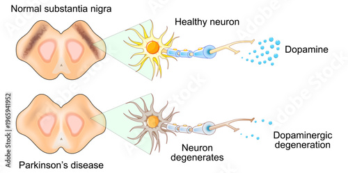 Parkinsons disease. Substantia nigra, Neuron degeneration and Dopamine level