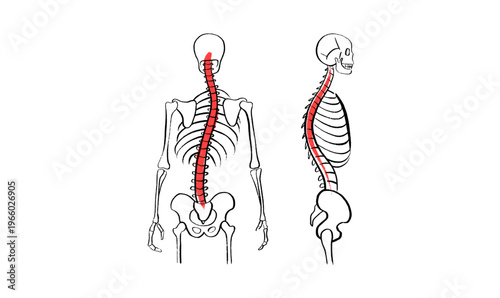 Scoliosis spine deformity