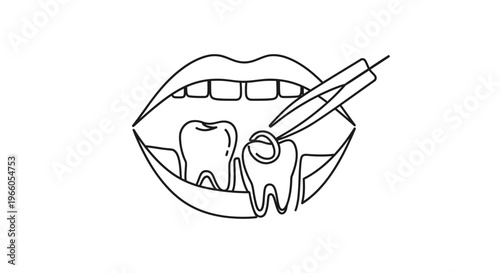 Dental Extraction: Forceps Removing Diseased Tooth from Open Mouth, Line Art