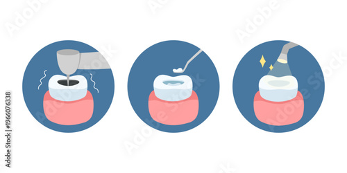 \Root canal treatment process, dental treatment. Infographics for dentistry