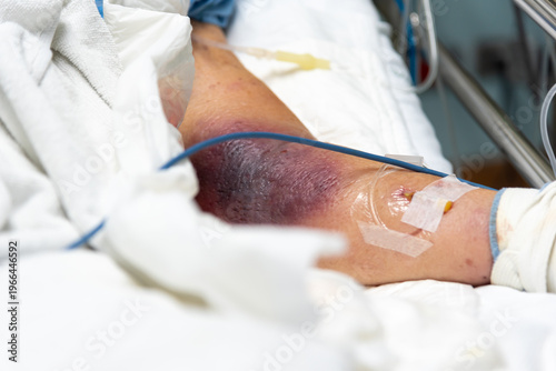 Foto Close up of patient arm with severe bruising and IV line in hospital showing inj