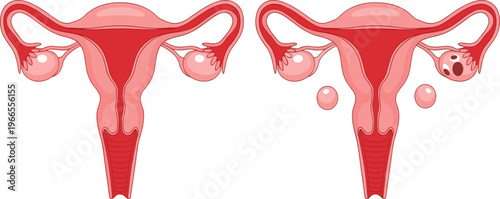 Anatomical Comparison of Female Reproductive System Showing Healthy Uterus and Ovarian Abnormalities with Cysts for Medical Education Gynecology Clinics and Healthcare Illustrations