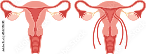 Female Reproductive System Anatomy Vector Set Showing Uterus Ovaries and Fallopian Tubes for Medical Education Healthcare Infographics and Gynecology Science Designs