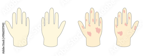 きれいな手と荒れた手のイメージイラスト