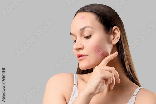 Young woman with acne probl...