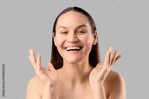 Happy young woman with acne...