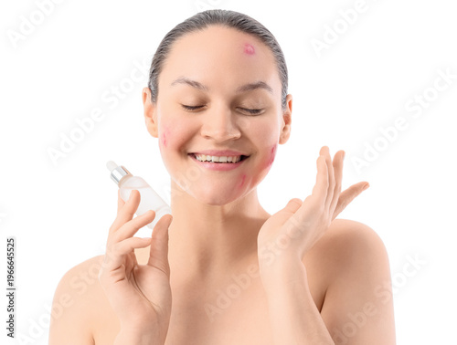 Happy young woman with acne...
