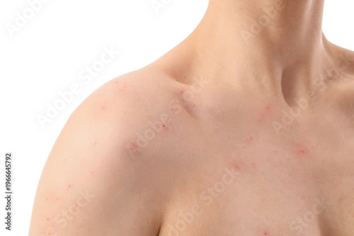 Female body with acne probl...