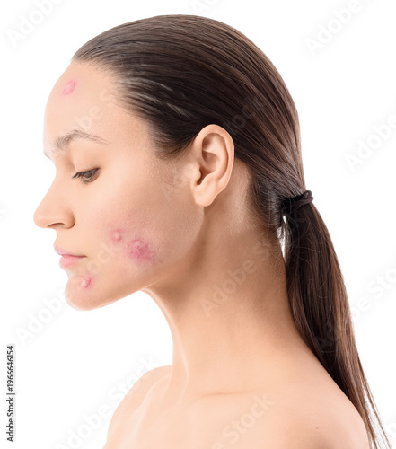 Young woman with acne probl...