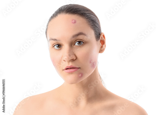 Young woman with acne probl...