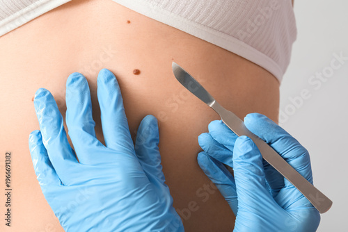Photos Surgeon with scalpel and mole on woman's belly against light background, closeup