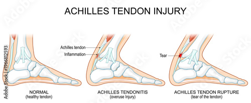 Achilles tendon injury. Healthy anatomy and the progression from tendinitis to rupture