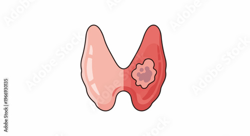 Stylized illustration of a human thyroid gland with a diseased section