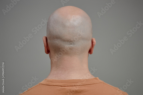 Bald head with hair loss in studio back view wellness concept