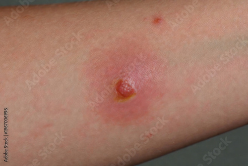 Close-up of a painful red inflamed skin lesion with a blister and pus
