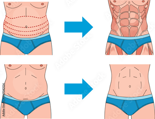 Abdominal fat reduction concept vector, belly transformation illustration, weight loss and muscle definition, fitness body change before after, healthy lifestyle design