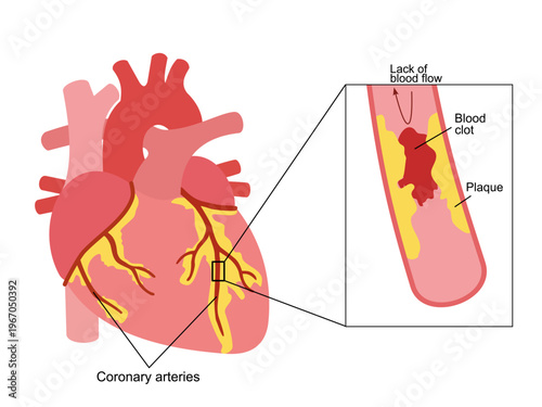 Medical illustration of coronary artery disease showing plaque buildup and blood clot in the heart. Educational diagram with labels for healthcare and science.