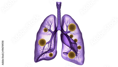 Obraz na płótnie Purple lungs with yellow nodules, isolated on transparent background
