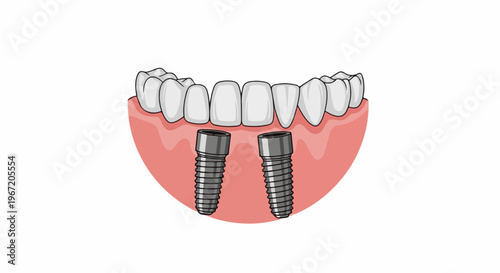 Illustration of dental implants supporting upper teeth