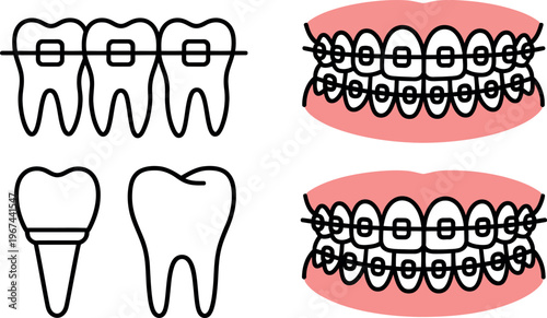 Illustrations of teeth undergoing orthodontic treatment with dental braces and implants shown