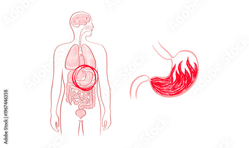 Gastroesophageal reflux pain