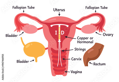 Female internal anatomy with a copper or hormonal IUD positioned in the uterus, illustrating contraception for women's health