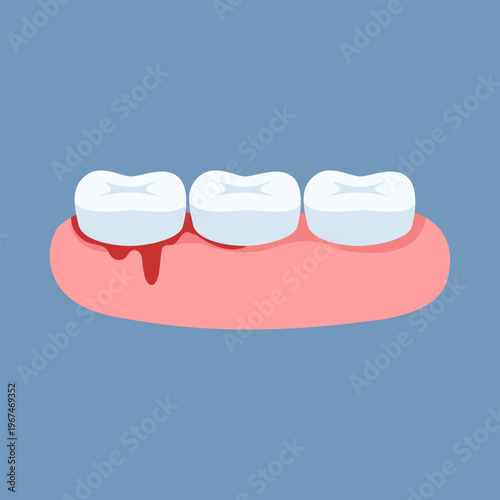 Illustration of the problem of bleeding gums. Dentistry