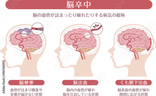 Stroke types medical infographic brain infarction cerebral hemorrhage subarachnoid hemorrhage explanation