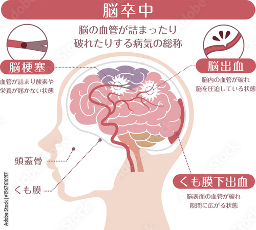 Stroke Types Medical Illustration	