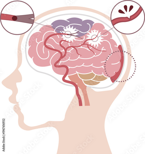 Stroke Types Medical Illustration	