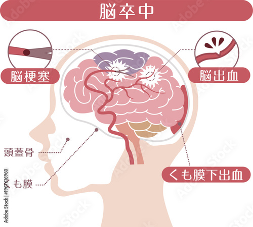 Stroke Types Medical Illustration	