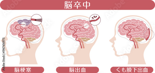 Stroke types brain infarction cerebral hemorrhage subarachnoid hemorrhage medical illustration	
