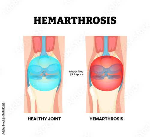 Hemarthrosis joint knee disease. Labeled blood filled joint space. Hemarthrosis vascular rupture bleeding accumulation. Synovial joint anatomy. Frontal view of human knee joint. Vector illustration.