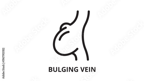 A simple line drawing illustration of a bulging vein, often used in medical contexts to depict circulatory issues or vascular health.