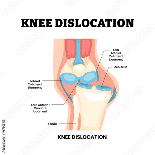 Knee dislocation joint knee disease. Labeled tear ligament, meniscus, torn ligament, fibula. Acute trauma injury mechanism. Synovial joint anatomy Frontal view of human knee joint Vector illustration.