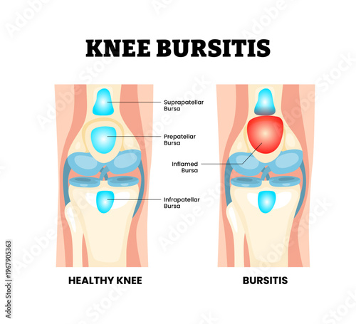 Knee Bursitis joint knee disease. Labeled inflamed bursa. Fluid swelling pain redness. Synovial joint anatomy. Frontal view of human knee joint. Vector illustration.