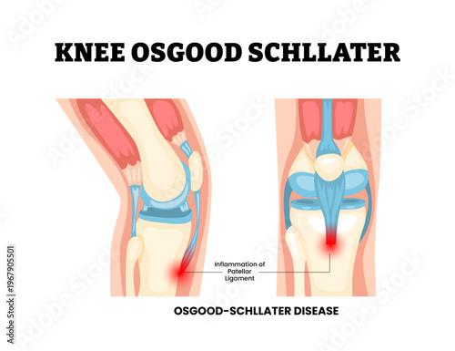 Knee osgood schlatter joint knee disease. Labeled inflamed patellar ligament Tibial tuberosity inflammation and traction apophysitis Synovial joint anatomy. Frontal and side view. Vector illustration.