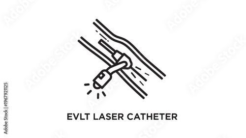 Detailed 3D render of an EVLT laser catheter device used in endovenous laser therapy for varicose veins. Ideal for medical, healthcare, and educational materials on minimally invasive procedures.