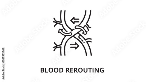 a medical illustration depicting blood rerouting, a surgical procedure to redirect blood flow, used in healthcare, medicine, and education