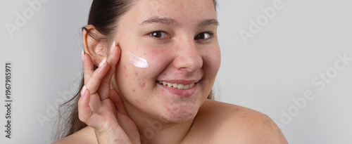 Tableau sur toile Pimple treatment cream on cheek