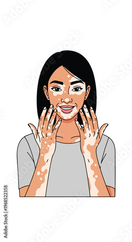 Illustration of a woman with vitiligo skin condition touching her own face gently