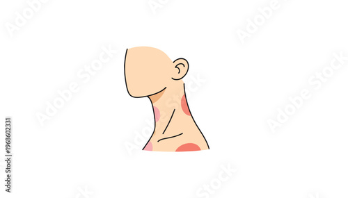 Hives on a persons neck flat vector illustration. Skin allergy and dermatology concept. Isolated on transparent background