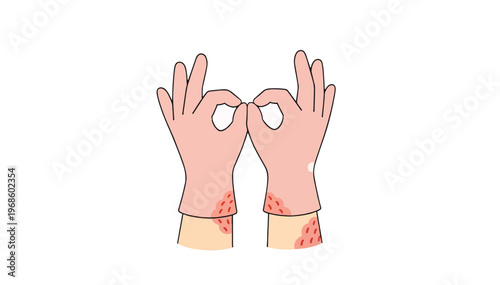 Latex glove allergy and skin rash concept. Hands with dermatitis symptoms. Flat vector illustration isolated on transparent background