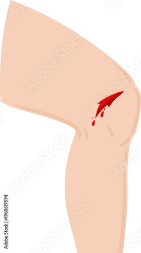 Leg showing bleeding cut wound on knee