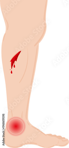 Human leg with wound and ankle pain swelling