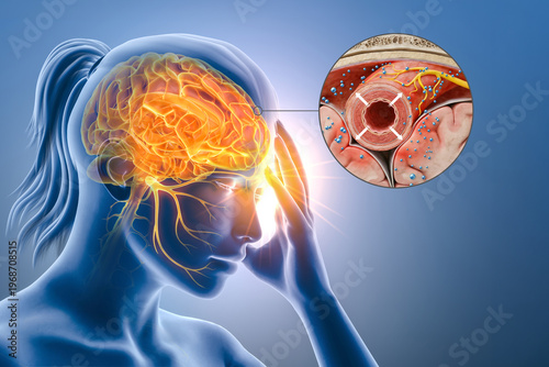 Migraine Pathophysiology. Trigeminal Nerve Activation and Neuroinflammation in the Brain