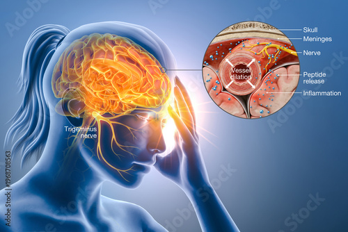 Migraine Pathophysiology. Trigeminal Nerve Activation and Neuroinflammation in the Brain